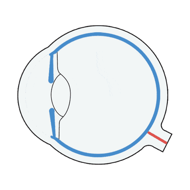 成都借卵试管(角膜薄还能做近视手术吗?看看郑州ICL晶体植入术)