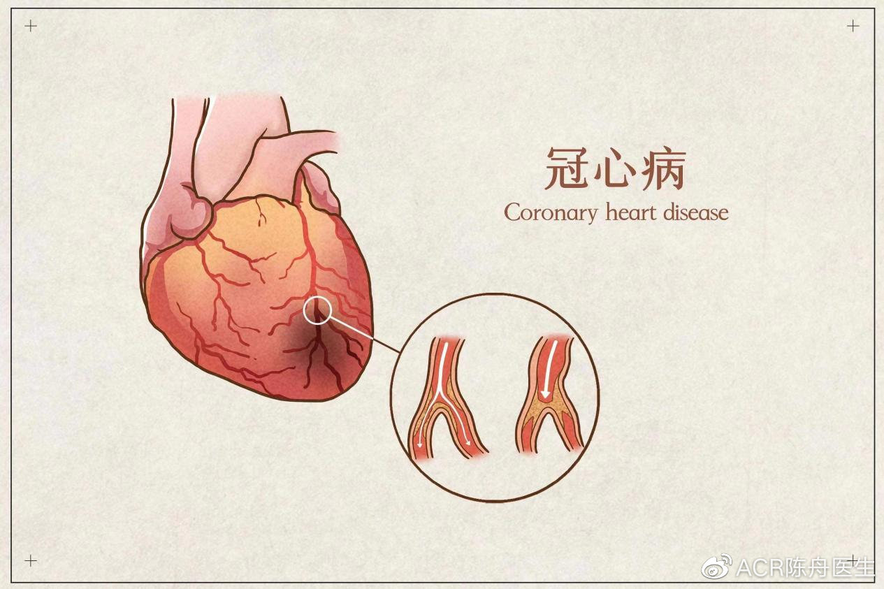 中老年冠心病患者能运动吗？可以选择哪些运动方式