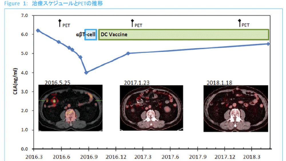 日本免疫细胞疗法之复发结直肠癌