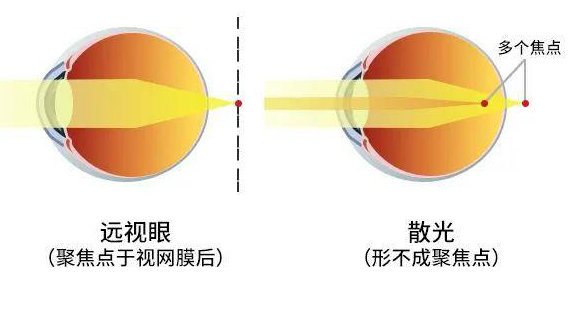 眼睛里长了“膜”，对视力损害大！把握手术时机是关键！