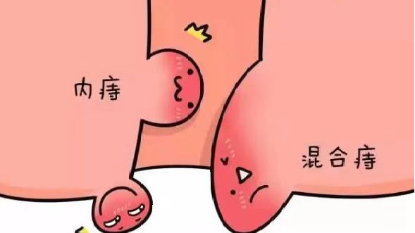 北京东大肛肠医院讲解：夏天做痔疮手术是不是容易感染？