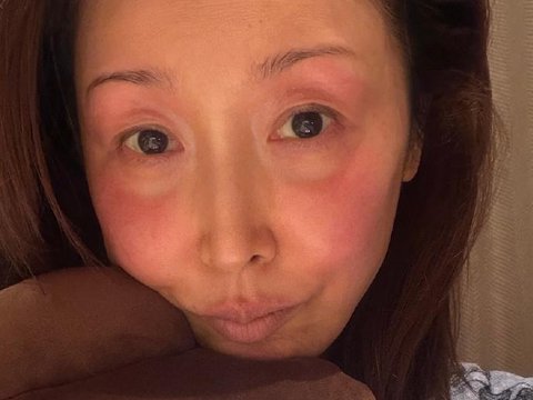 孙悦自曝录春晚被冻伤了！皮肤红肿，眼睛都已经充血了，令人心疼