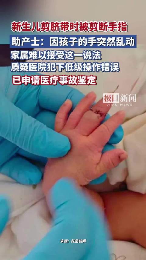 新生儿剪脐带时被剪断手指，助产士称因孩子的手突然乱动，家属难以接受这一说法，质疑医院犯下低级操作错误，已申请医疗事故鉴定