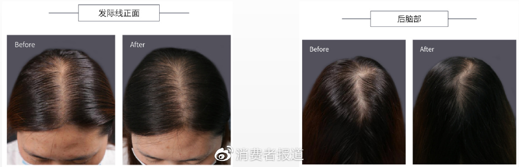 当代年轻人“脱发”图鉴:我“秃”了?我装的休闲区蓝鸢梦想 - Www.slyday.coM 当代年轻人“脱发”图鉴:我“秃”了?我装的休闲区蓝鸢梦想 - Www.slyday.coM