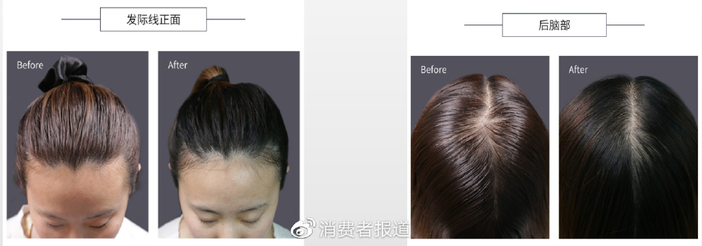 当代年轻人“脱发”图鉴:我“秃”了?我装的休闲区蓝鸢梦想 - Www.slyday.coM 当代年轻人“脱发”图鉴:我“秃”了?我装的休闲区蓝鸢梦想 - Www.slyday.coM