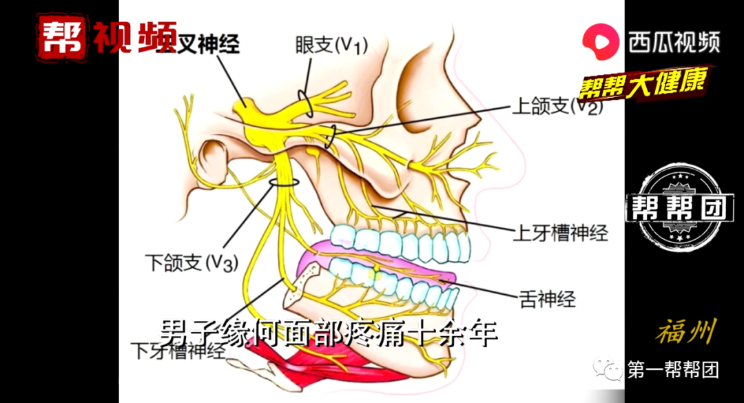 男子单侧面部疼痛十几年,就医后竟是患上"天下第一痛"