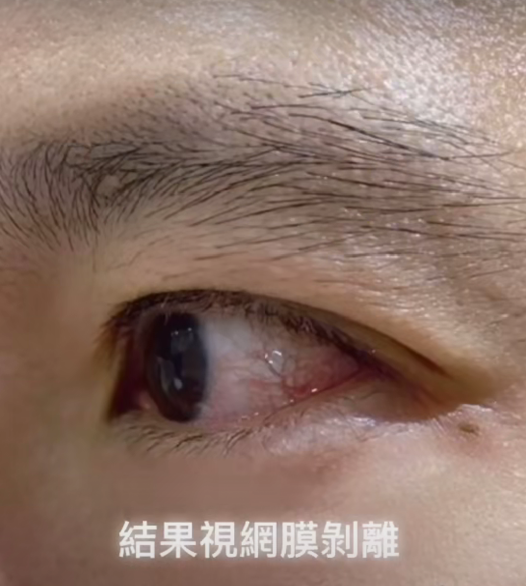 从照片中可以看到,立威廉受伤的这只眼睛现在布满了红血丝,眼球也有些