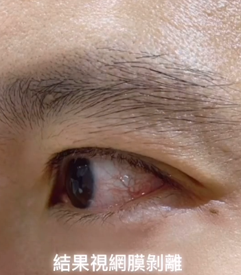 44岁立威廉左眼被女儿踢致视网膜剥离,术后眼睛发红照曝光
