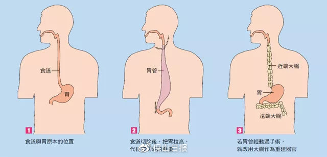 新突破龙陵县人民医院独立开展县域首例胸腹腔镜联合食管癌根治术