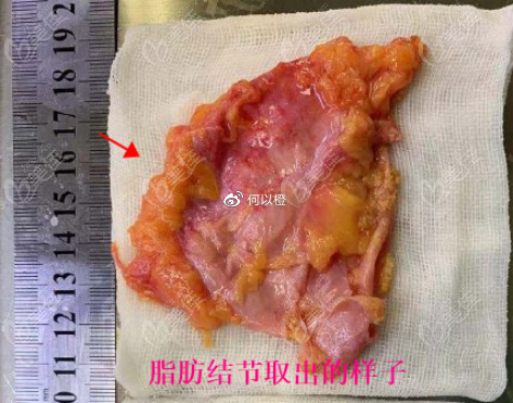 脂肪隆胸后有些患者可能会出现硬结,钙化,囊肿,感染,或者皮肤坏死等