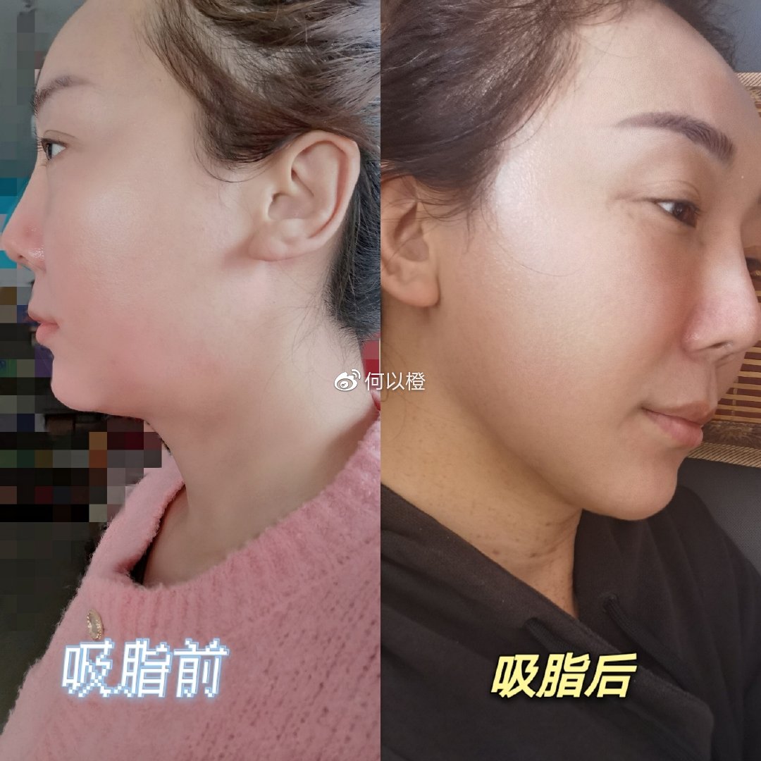 下颚线不明显，听说<a href=