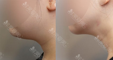 下颚线不明显，听说<a href=