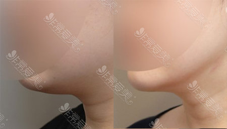 下颚线不明显，听说<a href=