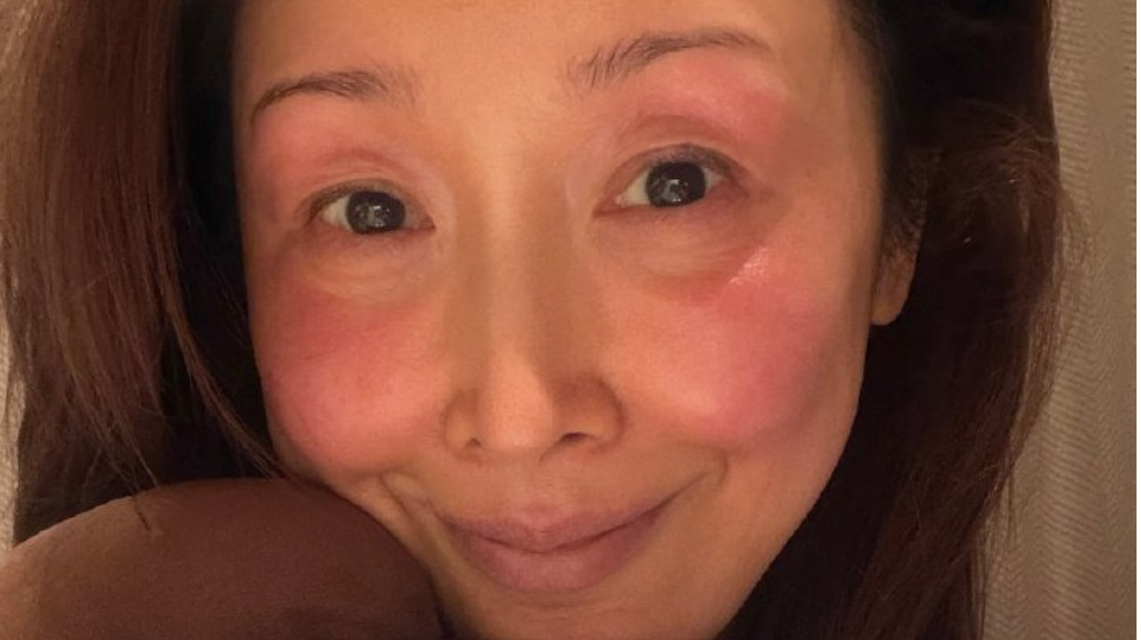 孙悦录春晚脸被冻伤，眼圈、脸颊部分呈现出粉红色