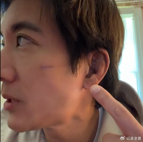 王力宏成都演唱会摔伤：39针背后拆弹专家-华西口腔李继华团队