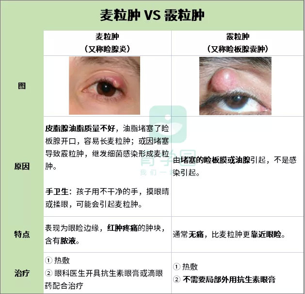 霰粒肿和麦粒肿是两种不同的眼部疾病,一开始症状相似,但霰粒肿的丘疹