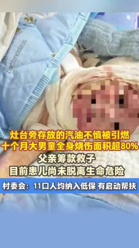 十个月大男童全身烧伤超80%，父亲筹款救子村委会启动帮扶