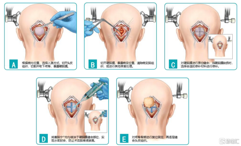 赛克赛斯三闯IPO，专注于医疗器械领域，近5年累计分红3.23亿元