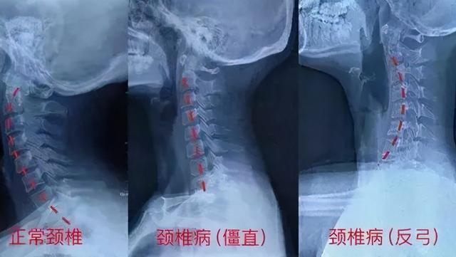 正文   检查显示,小陈的颈椎严重变形,已无法进行正常的生理弯曲.