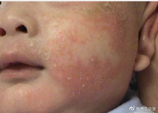 宝宝湿疹总不好,可能你是用错了药!正确方法看这里休闲区蓝鸢梦想 - Www.slyday.coM 宝宝湿疹总不好,可能你是用错了药!正确方法看这里休闲区蓝鸢梦想 - Www.slyday.coM