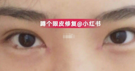 我种草的内眼角修复医生，附带国内和<a href=