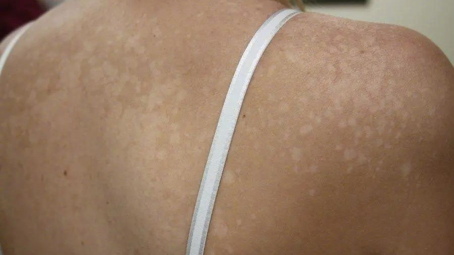 花斑癣俗称汗癣，使用天萃草霜的乳膏居然好了，这是为什么？