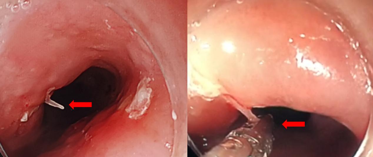 鱼刺卡喉,阿婆硬吞饭团扎到主动脉!休闲区蓝鸢梦想 - Www.slyday.coM 鱼刺卡喉,阿婆硬吞饭团扎到主动脉!休闲区蓝鸢梦想 - Www.slyday.coM