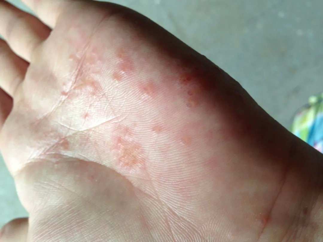 Erythematous Papules and Vesicles on the Palms, Soles, and Oropharynx ...