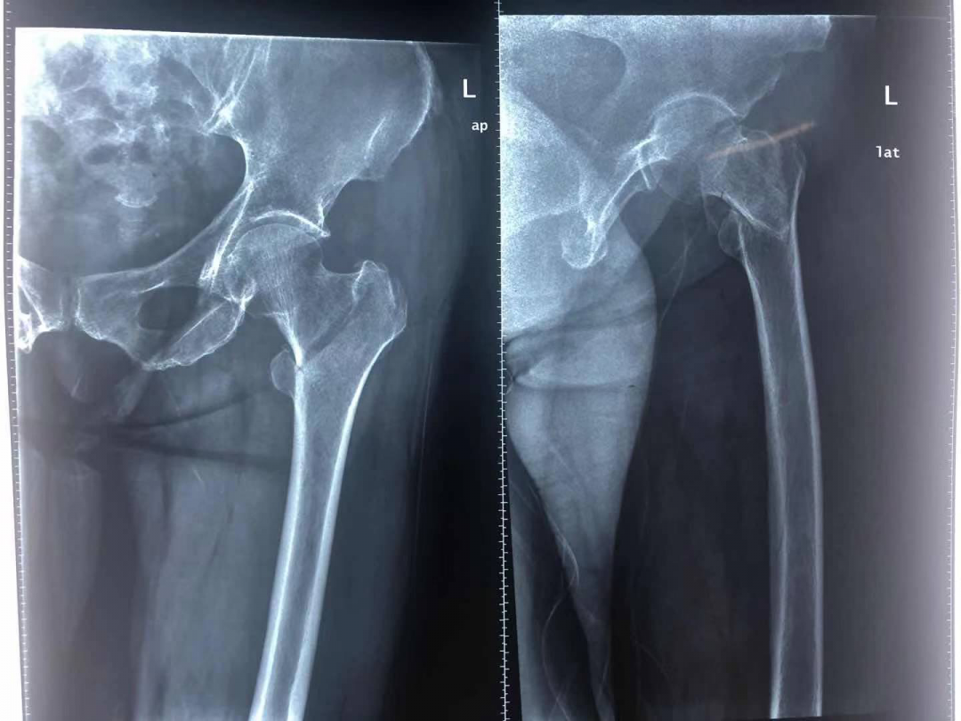 左侧股骨转子间骨折（AO分型 A2.1）-病例讨论-唯医,allinmd