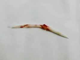 鱼刺卡喉,阿婆硬吞饭团扎到主动脉!休闲区蓝鸢梦想 - Www.slyday.coM 鱼刺卡喉,阿婆硬吞饭团扎到主动脉!休闲区蓝鸢梦想 - Www.slyday.coM