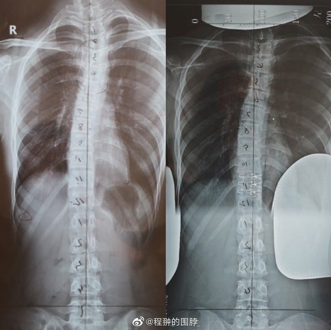 脊柱侧弯