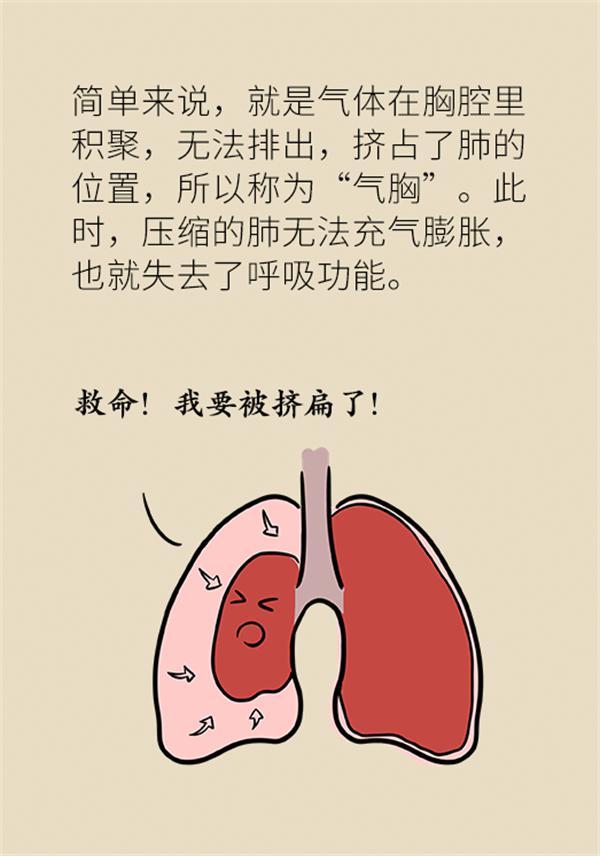 有种胸闷胸痛和心脏无关警惕双侧气胸