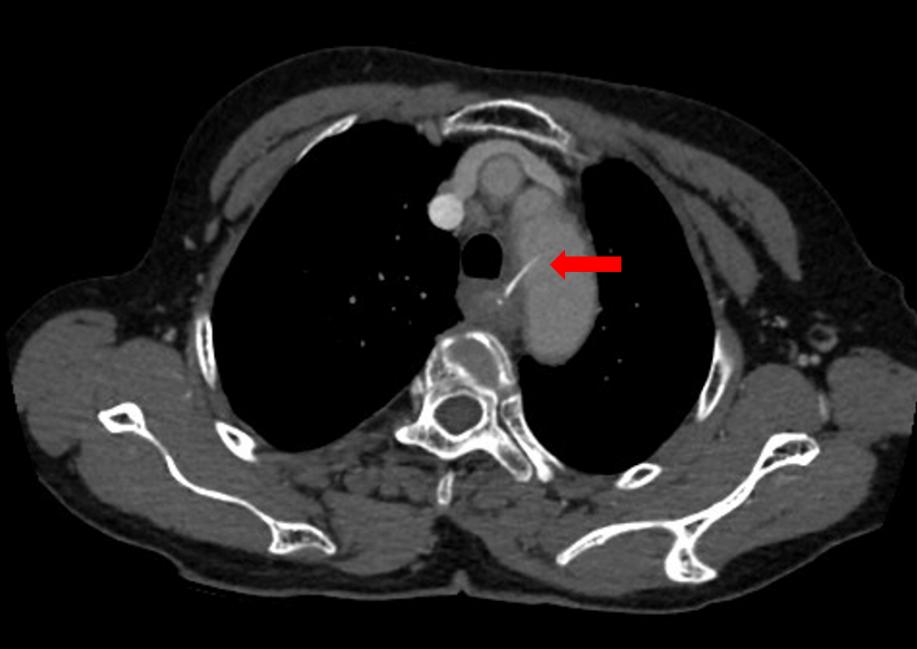 鱼刺卡喉,阿婆硬吞饭团扎到主动脉!休闲区蓝鸢梦想 - Www.slyday.coM 鱼刺卡喉,阿婆硬吞饭团扎到主动脉!休闲区蓝鸢梦想 - Www.slyday.coM