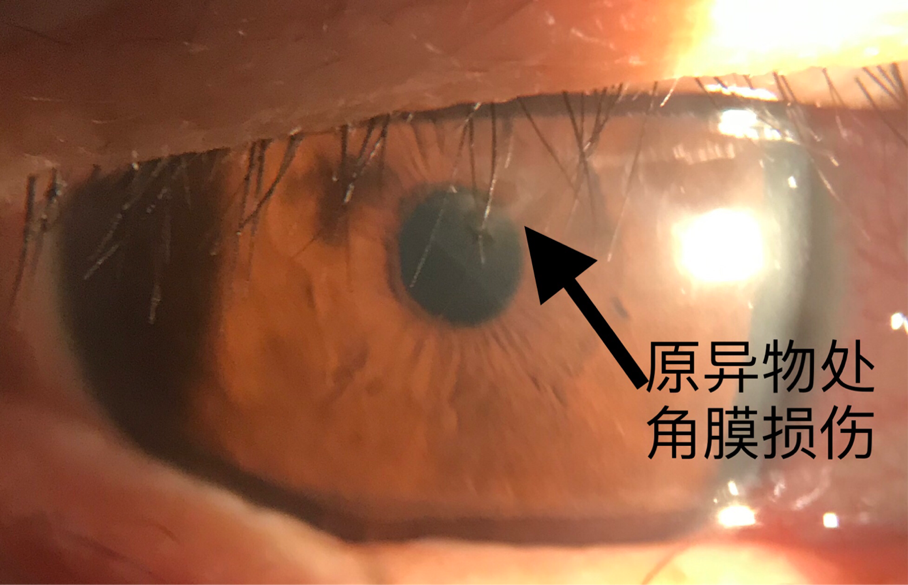正文                      如图:呈线状的就是角膜划痕.
