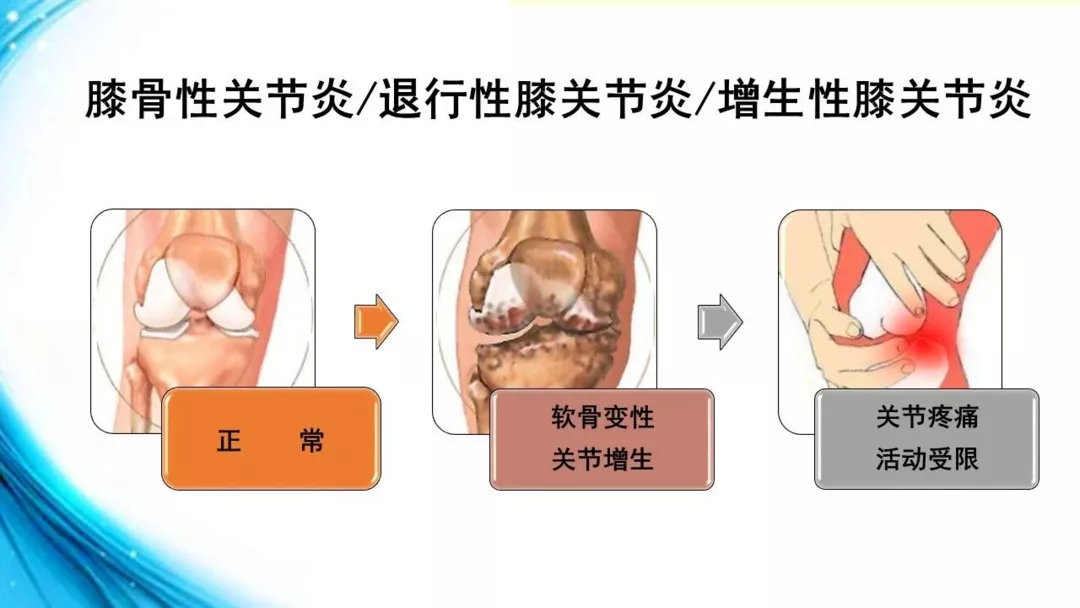 洪中病例膝骨性关节炎再发十年前的医生再出手