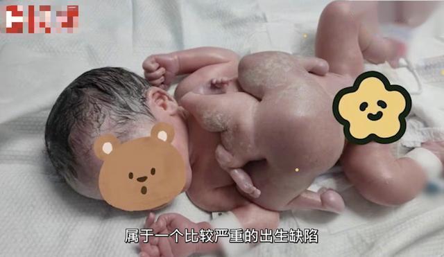 全球罕见!深圳一男婴出生时4手4脚,产妇选择生下来,只因一个理由休闲区蓝鸢梦想 - Www.slyday.coM 全球罕见!深圳一男婴出生时4手4脚,产妇选择生下来,只因一个理由休闲区蓝鸢梦想 - Www.slyday.coM