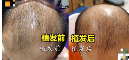 广州供卵公司(2022郑州植发功课必看!郑州发际线种植哪里做得好?)