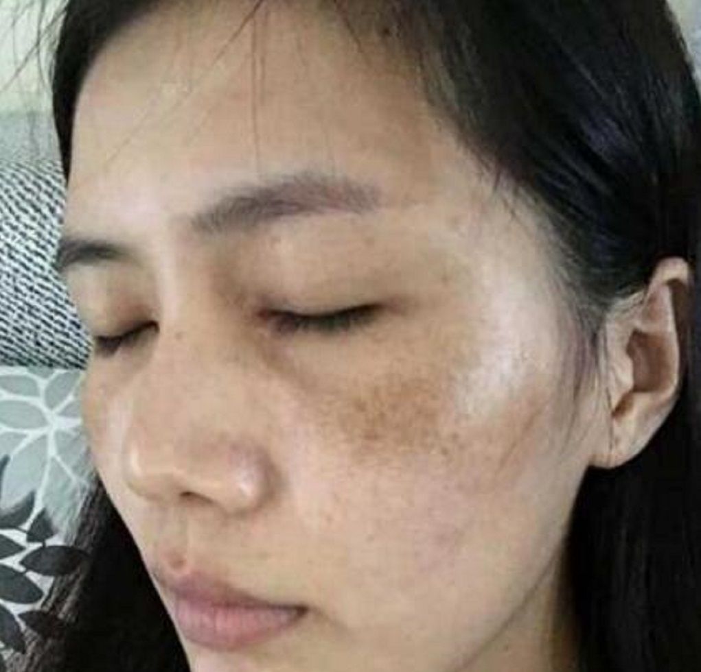 脸上有色斑的妹子,赶紧试试这3个小妙招,不出半月,恢复白嫩肌