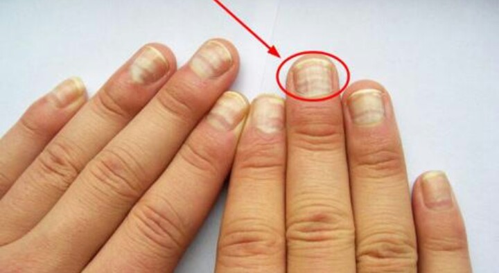 其实从指甲上也能看到身体健康的好坏,不是看指甲上月牙的多少,而是看