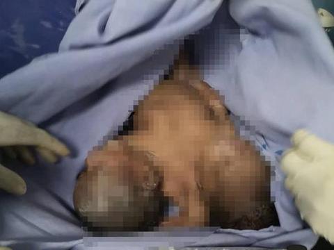 中国医生为莫桑比克产妇实施分娩术成功诞下双胞胎连体婴儿