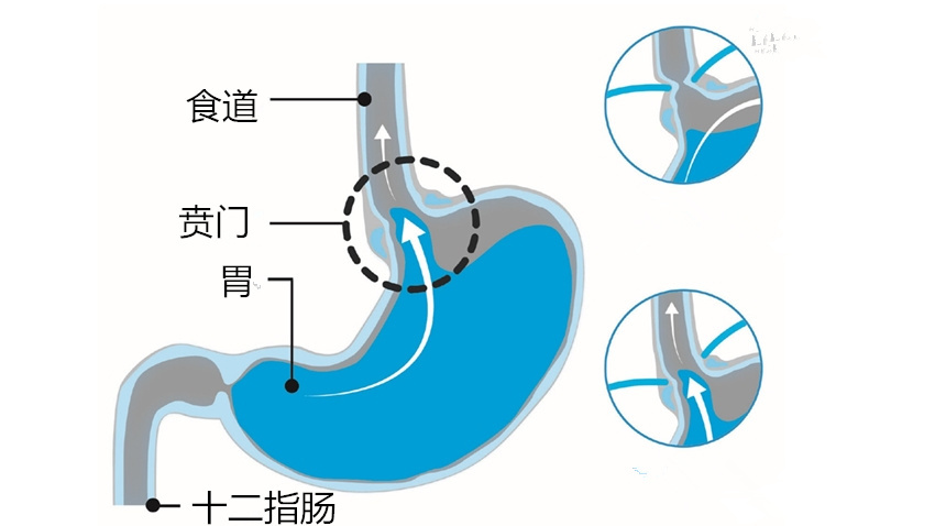 揪出胃食道逆流3大原因别让食管癌找上你