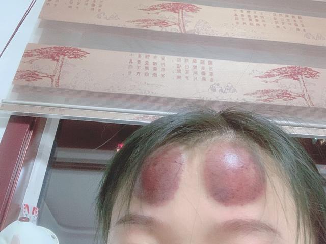 那个告诉我媳妇说额头上拔罐能治头疼的人你的良心不会痛吗