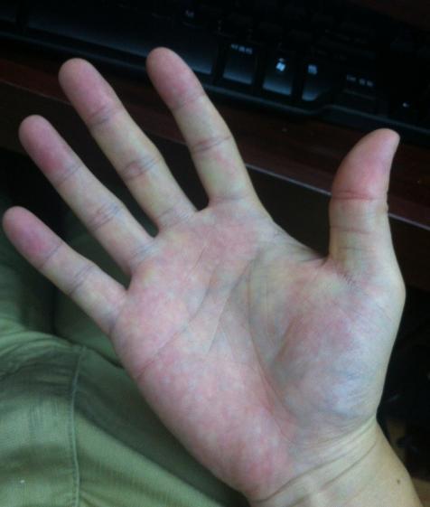3,手掌异常情况严重者,还会出现脂肪肝,并且伴有浮肿的现象.