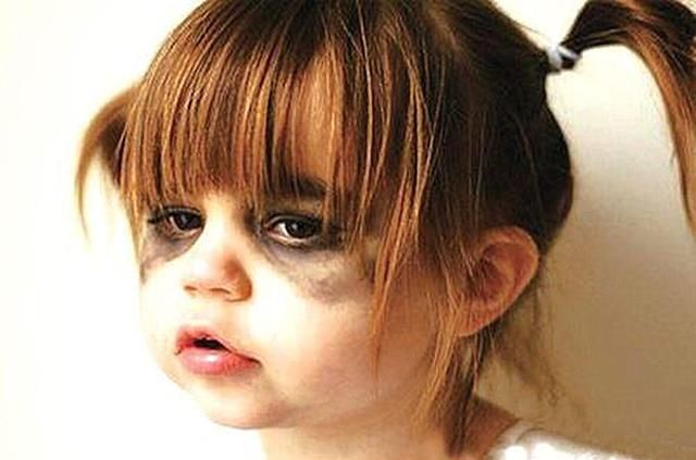 罗志祥黑眼圈热议,你知道孩子也有黑眼圈吗?小心隐含疾病