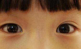 “娃长双眼皮是好看，可我很害怕”，娃眼皮突然变双，到底暗示啥