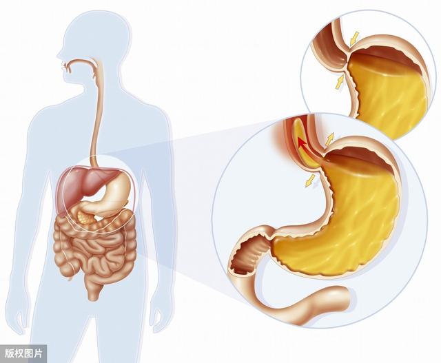胃反酸,吐酸水,难受还易伤食道,远离这4种食物,胃会感谢你