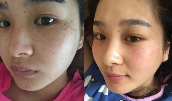 红霉素软膏加一物敷脸,15天美白肌肤淡化色斑,赶紧去备上一支
