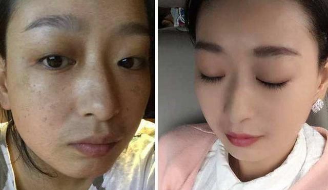 红霉素软膏加一物敷脸,15天美白肌肤淡化色斑,赶紧去备上一支