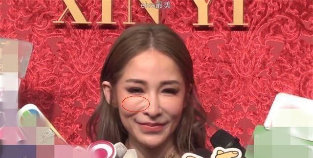 过度依赖“玻尿酸”!萧亚轩等女星的肿脸泡谁家强?生图太吓人