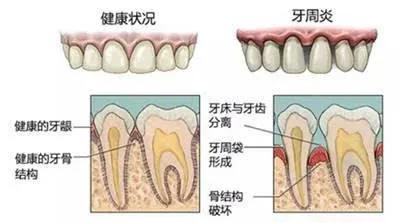 牙齿支持组织包括牙龈,牙骨质,牙周膜和牙槽骨的一种慢性,破坏性疾病